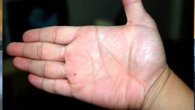nốt ruồi ở bàn tay trái nữ