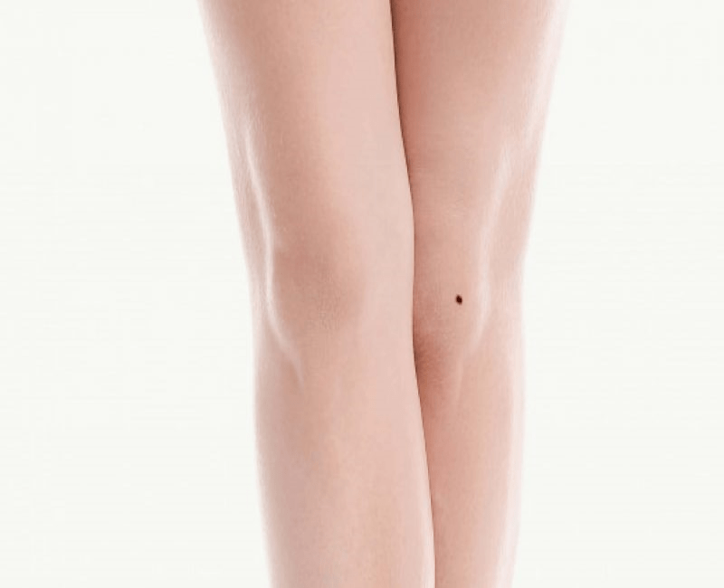 Nốt ruồi ở bắp chân trái phụ nữ 