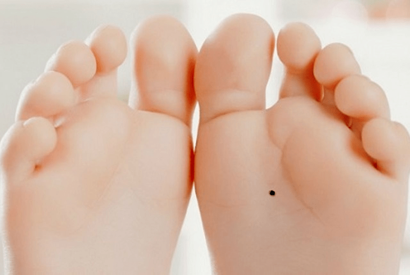 nốt ruồi ở lòng bàn chân trái