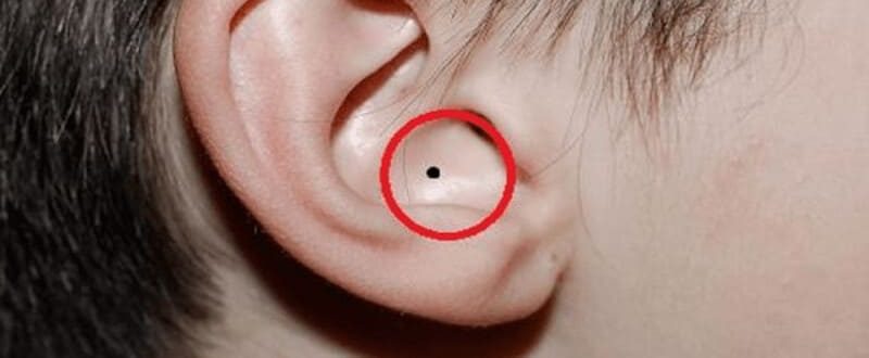 các vị trí nốt ruồi ở tai