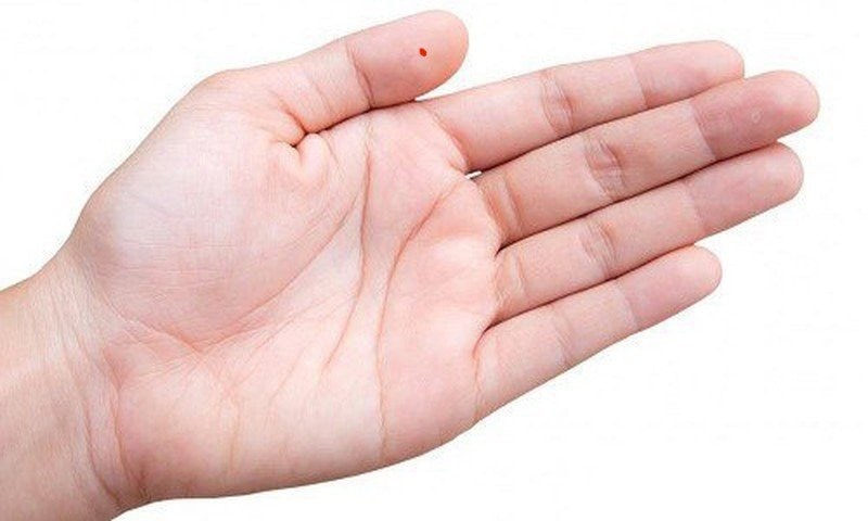 nốt ruồi son ở ngón tay cái