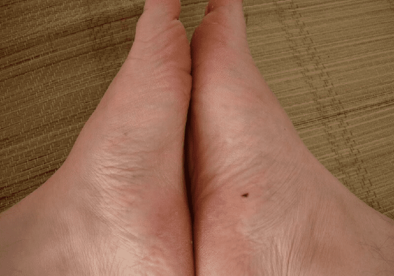 nốt ruồi ở lòng bàn chân phải của nữ