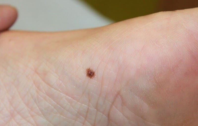 nốt ruồi ở lòng bàn chân phải của phụ nữ