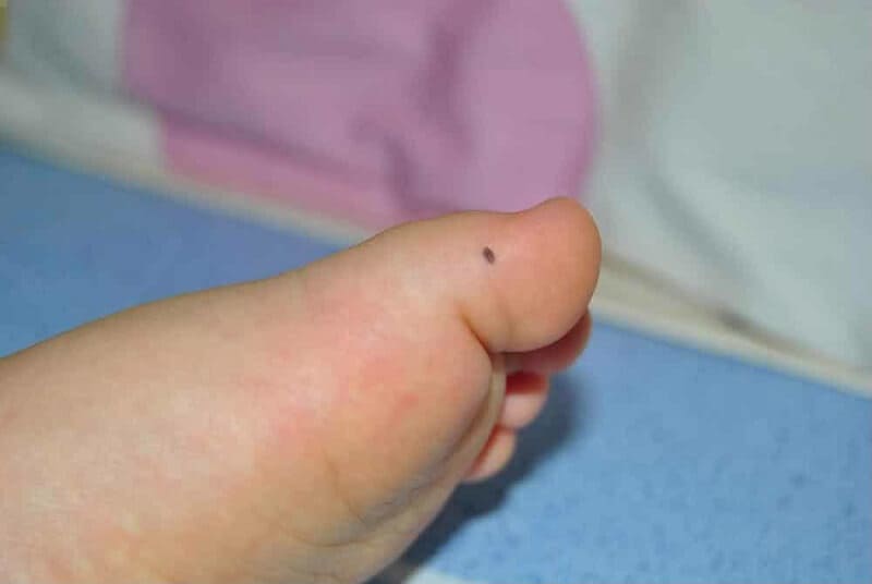 nốt ruồi ở lòng bàn chân phải của nữ